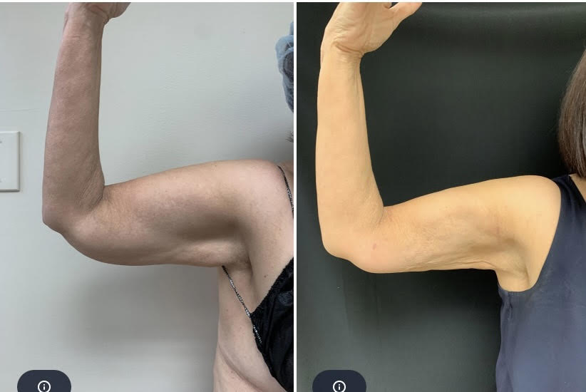 Best J Plasma Renuvion Skin Tightening RenuvionJ Plasma Body